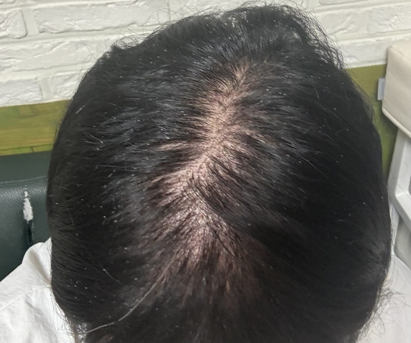 정수리 모발이식 11일차 실패한건가요?