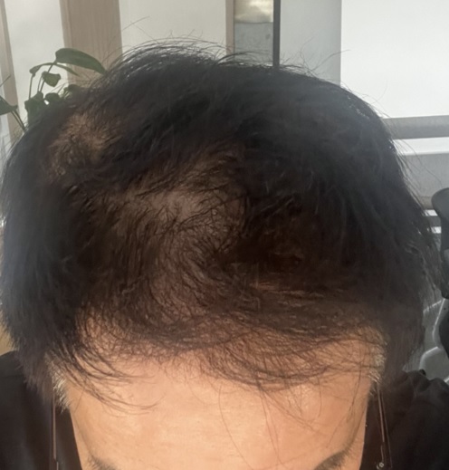 모발사진_현재.jpg