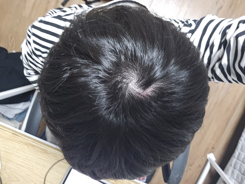 정수리 탈모인가요?