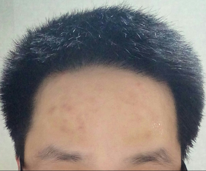 복용중단16일째