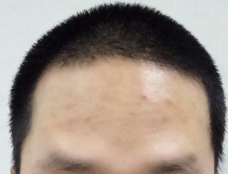 복용중단전