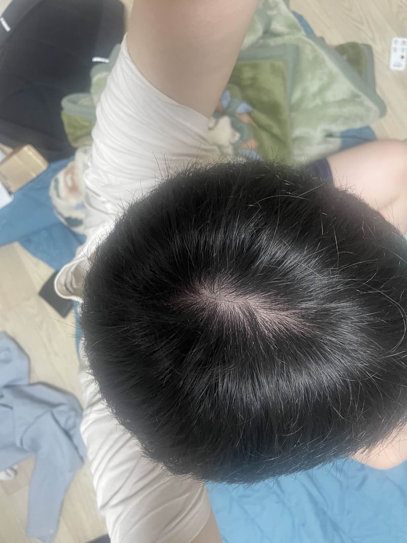탈모 진단 일주일차입니다. 뉴비 조언좀 구해봅니다