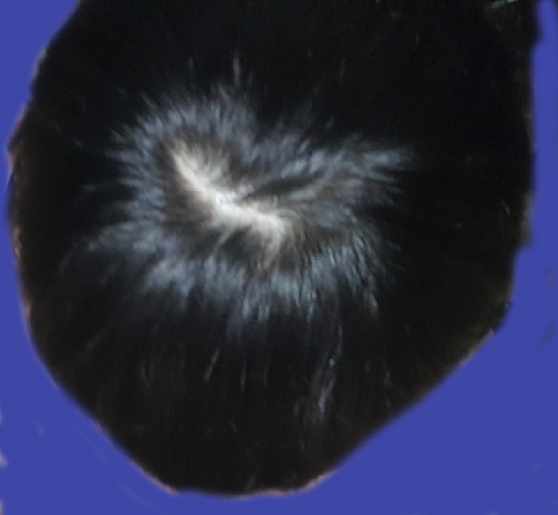정수리 탈모 2.jpg