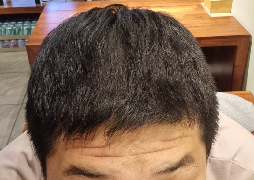 치료 후