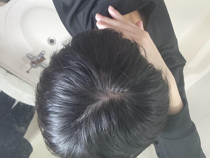탈모초기인가요?