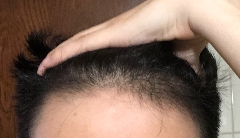 forhead.1.jpeg
