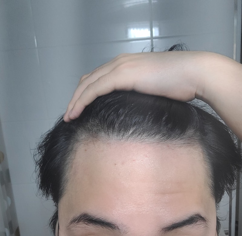 alopecia-20220329-214335-000.jpg