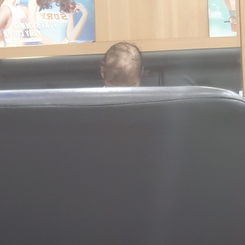 alopecia-20191217-203103-000.jpg