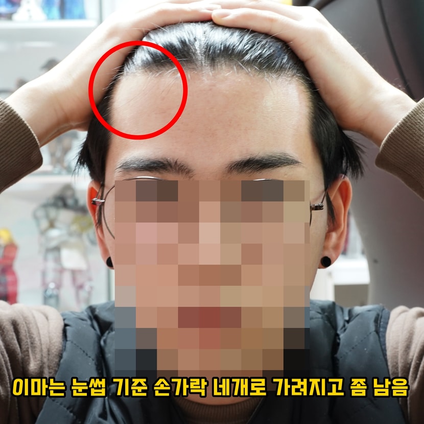 이마 깠을 때