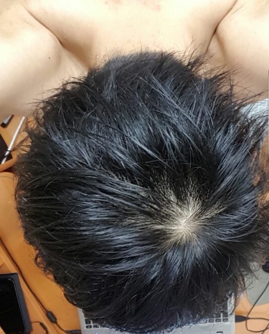 탈탈모.jpg