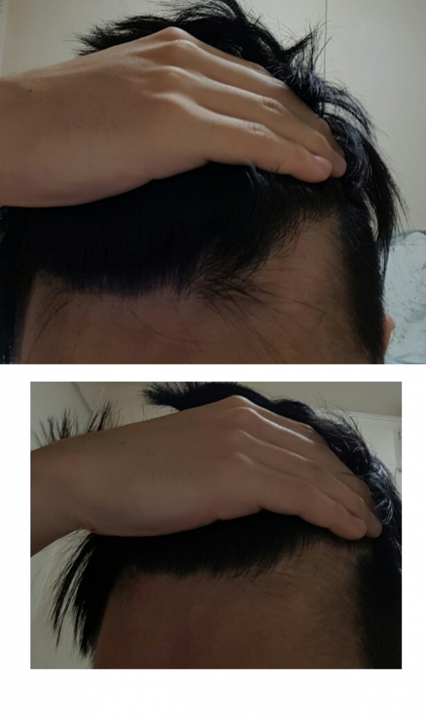 탈모3.png