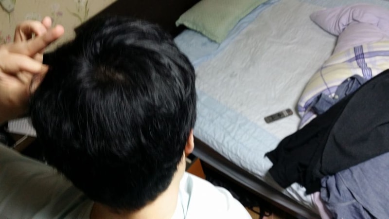 금딸2년후 두피상태.jpg