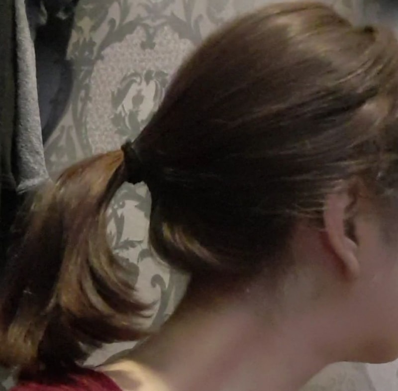 alopecia-20200217-113241-002.jpg