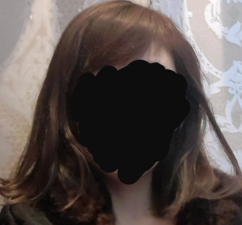 alopecia-20200217-113241-001.jpg