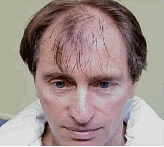 geo1_hair_transplant.gif