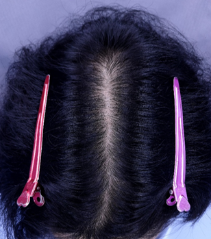 치료후 (1).png