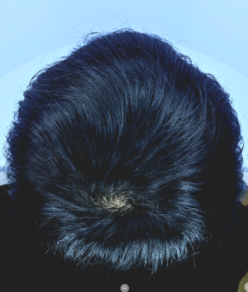 이수민92 치료후 3.png