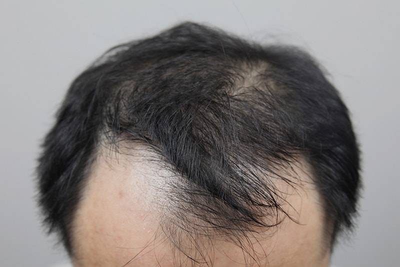 탈모치료5회2.jpg