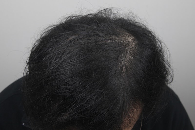 탈모치료15회2.jpg