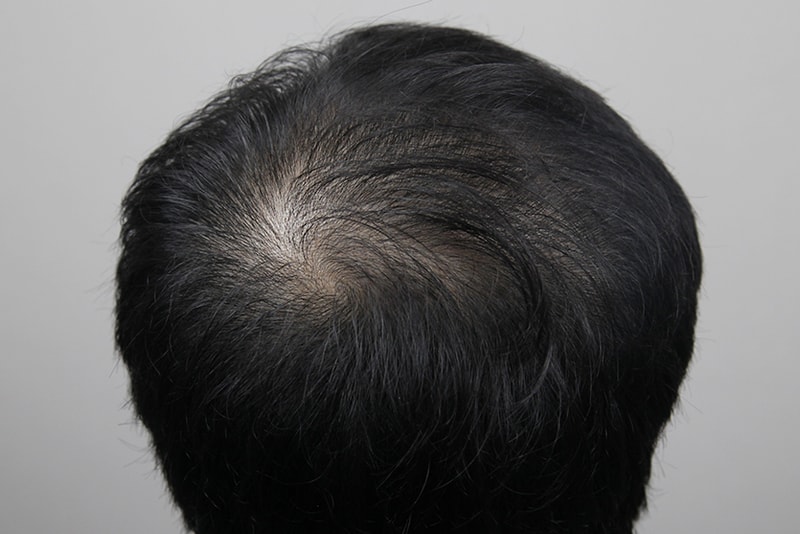 탈모치료10회.jpg