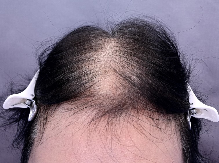 인천 연세모벨르의원 사이토카인 6개월 치료