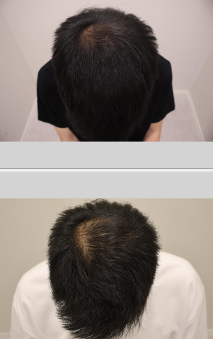 동탄 ㅎㅇㄹ 탈모 치료 후기입니다
