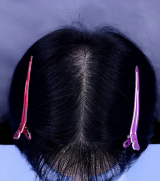 치료 후1.png