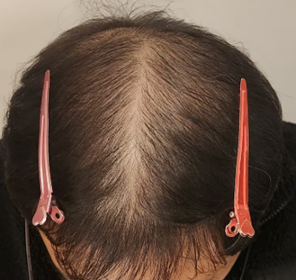 대구연세모벨르 주사치료 6개월 치료 후기