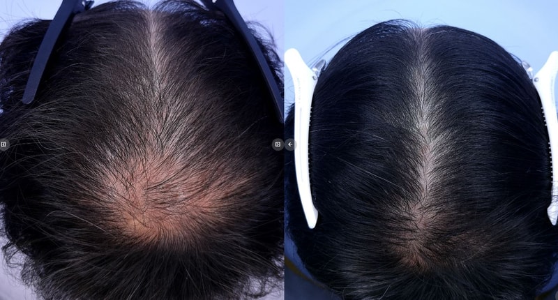 인천 연세모벨르의원에서 모낭 치료 1년후기