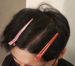 치료후.png