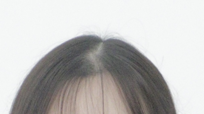 탈모치료톡