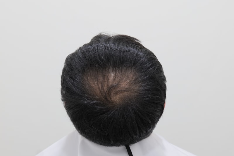 탈모치료톡