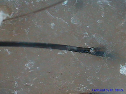 치료전1.png