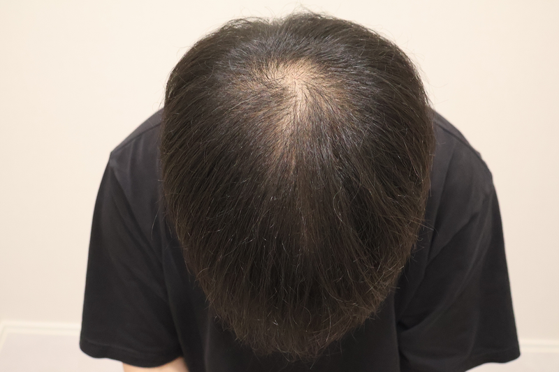 두피치료 10회받고 왔습니다.