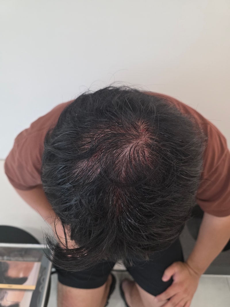 동탄헤어로 탈모치료 2회차 후기입니다.
