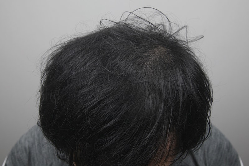 탈모치료20회2.jpg