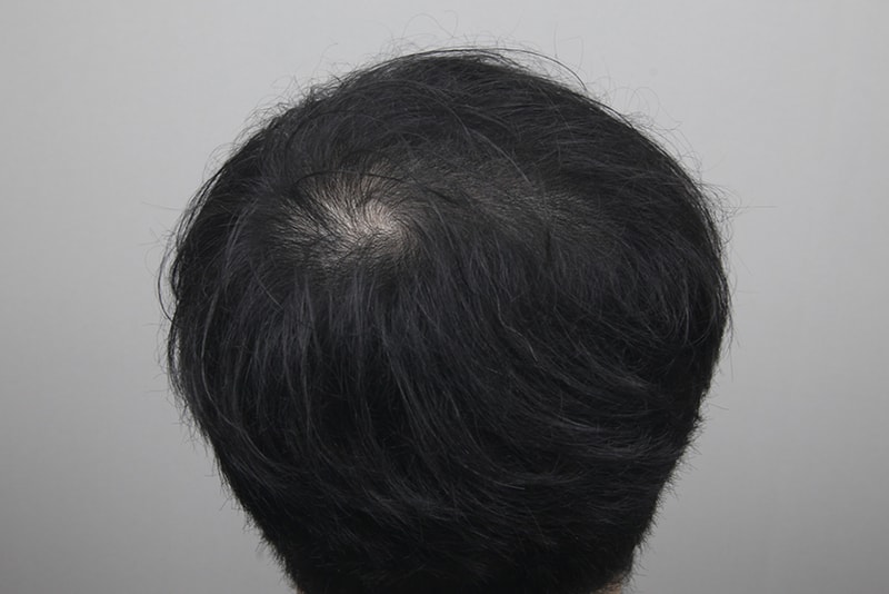 탈모치료20회.jpg