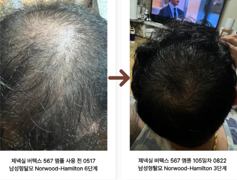 안녕하세요 국내 유일 3주 내로 눈에 띄는 머리(솜털) 안 날 시 무료 반품 해주는 제넥실 초고속 발모/탈모 브랜드입니다.