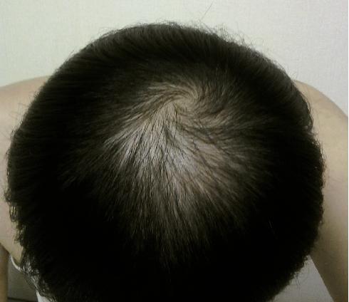 정수리.jpg