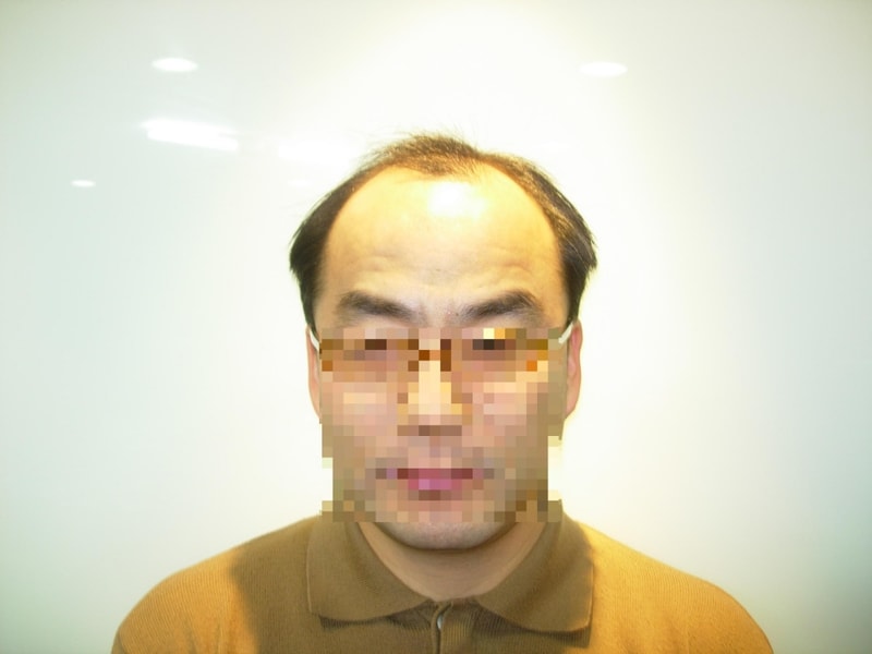 가발착용 일주일 평가좀 해주세요