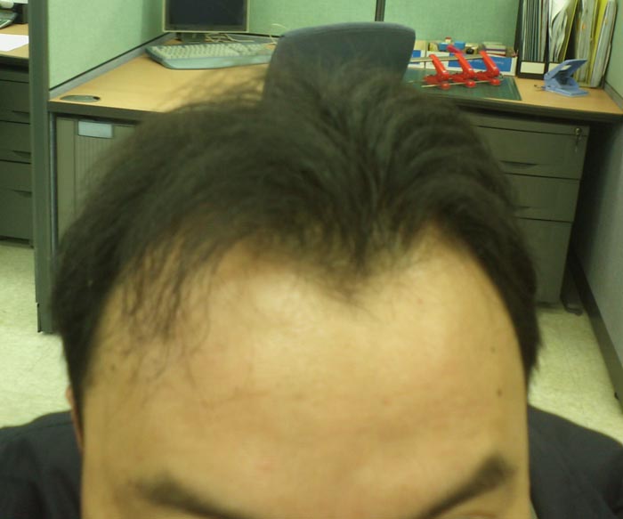 [사진]가발하는게 좋을까요??