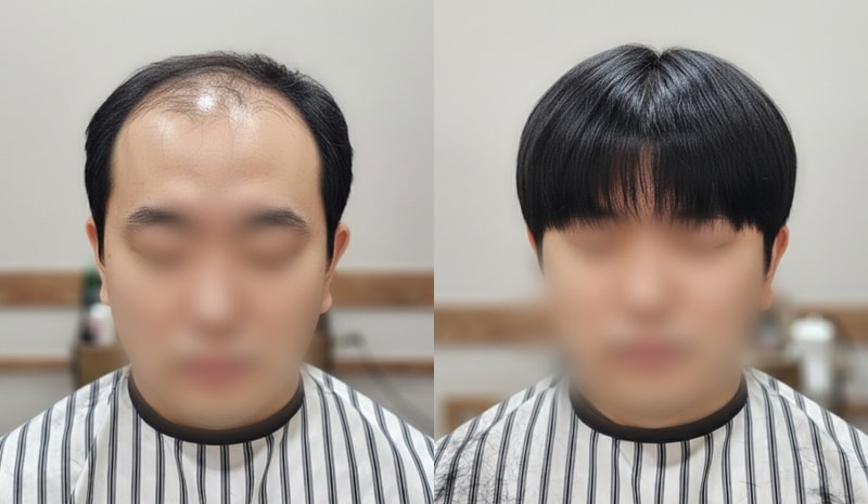 시스루 댄디 남자가발, 가발 느낌이 안 나는 이유 (가발닷컴 부평본점)