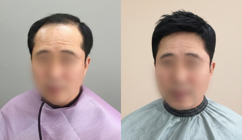 60多岁 男士 Regent cut定制假发B4&After