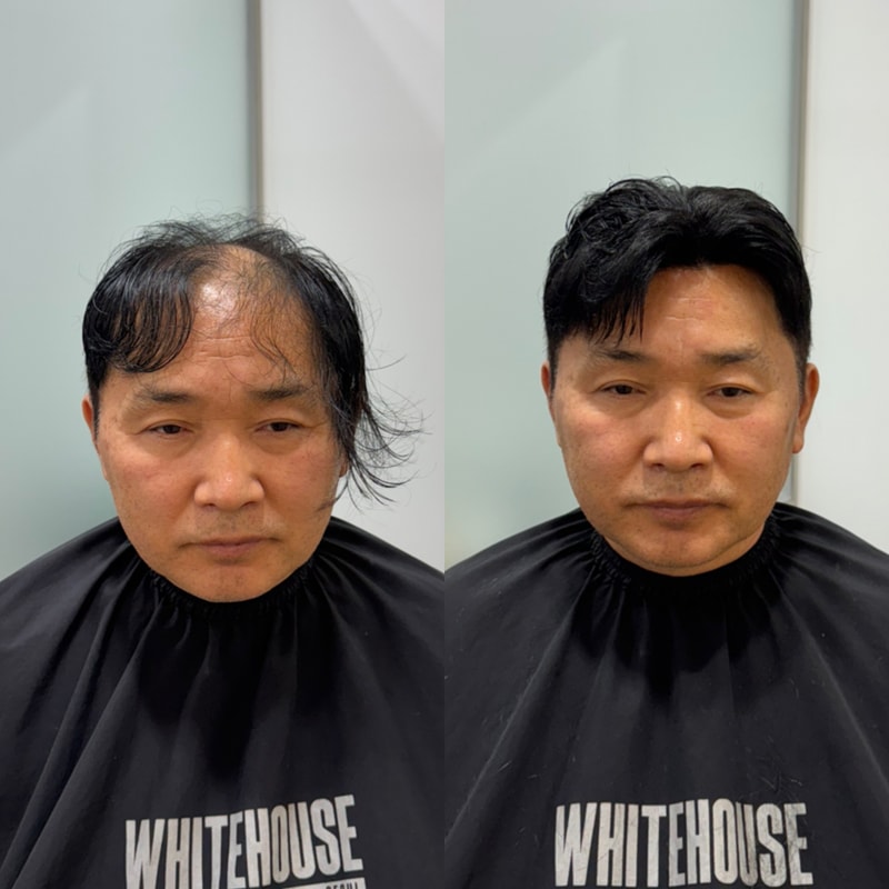 믿기지 않는 변화 화이트하우스서울 인천직영점 시술