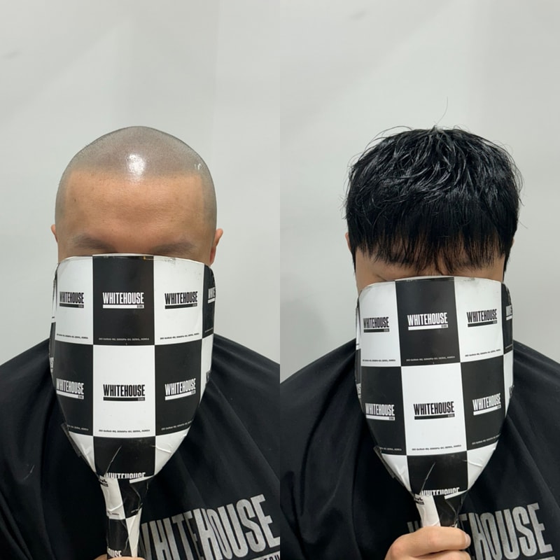 화이트하우스서울 인천직영점 삭발 상태에서도 자연스럽게 변한 전두 가발 후기