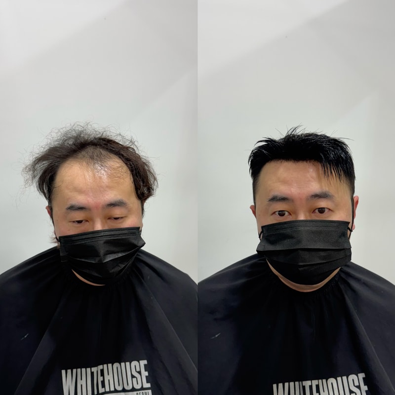 증모술 다른가발 써봤다면 차이를 아실 겁니다 그 차이는 화이트하우스서울 인천직영점에서
