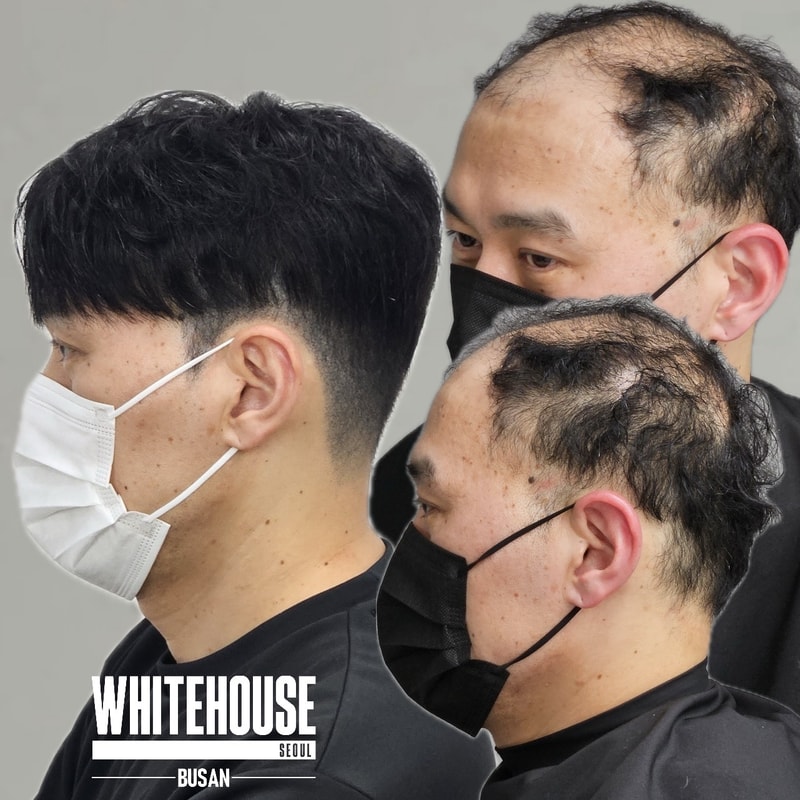 다발성탈모, 가발과 부산두피문신으로 해결해 보았습니다.