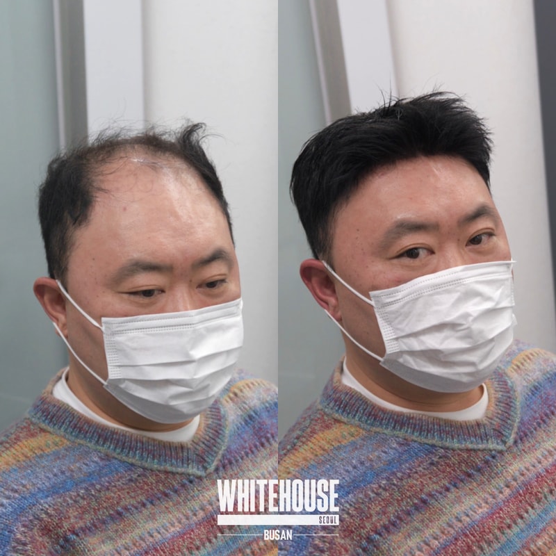 부산 짧은헤어스타일 가발 클립형 머리를 밀지않아도 착용이 가능합니다.