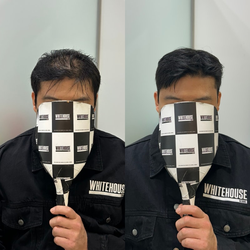 빽셋으로 헤어라인은 살리고 정수리 모량만 자연스럽게 커버해봤습니다화이트하우스서울 인천직영점