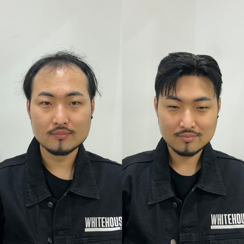화이트하우스인천직영점 파일컷 가발 시술해봤습니다